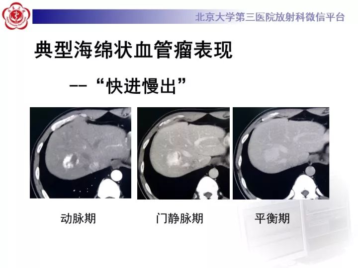 【PPT】肝脏血管源性肿瘤（一）
