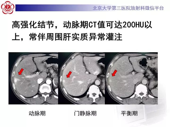 【PPT】肝脏血管源性肿瘤（一）
