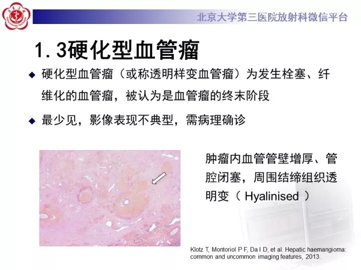 【PPT】肝脏血管源性肿瘤（一）