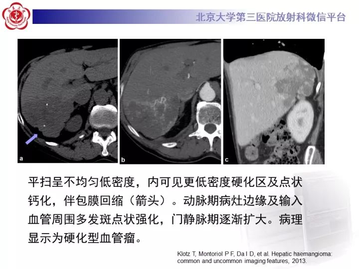【PPT】肝脏血管源性肿瘤（一）