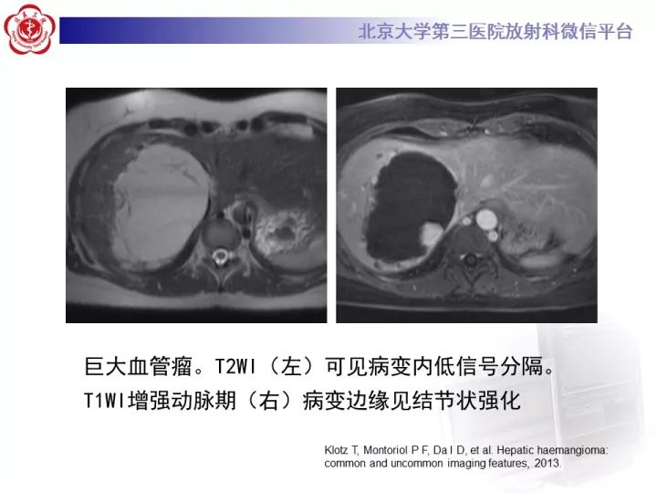 【PPT】肝脏血管源性肿瘤（一）