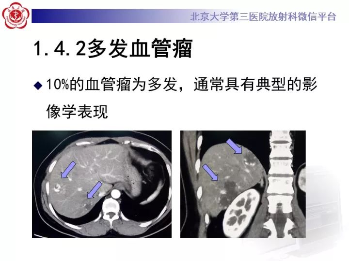 【PPT】肝脏血管源性肿瘤（一）