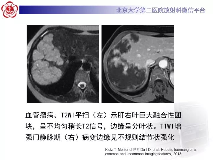 【PPT】肝脏血管源性肿瘤（一）