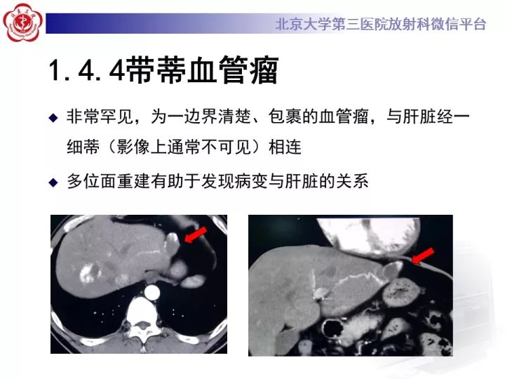 【PPT】肝脏血管源性肿瘤（一）