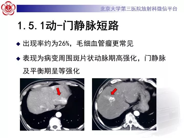 【PPT】肝脏血管源性肿瘤（一）