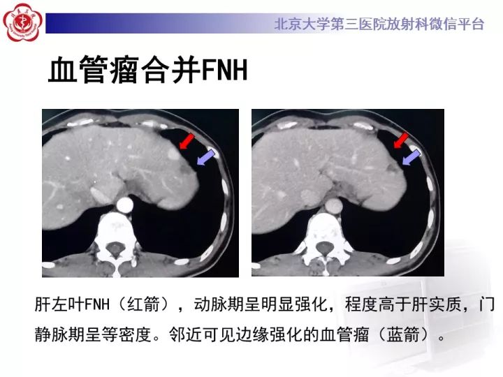 【PPT】肝脏血管源性肿瘤（一）