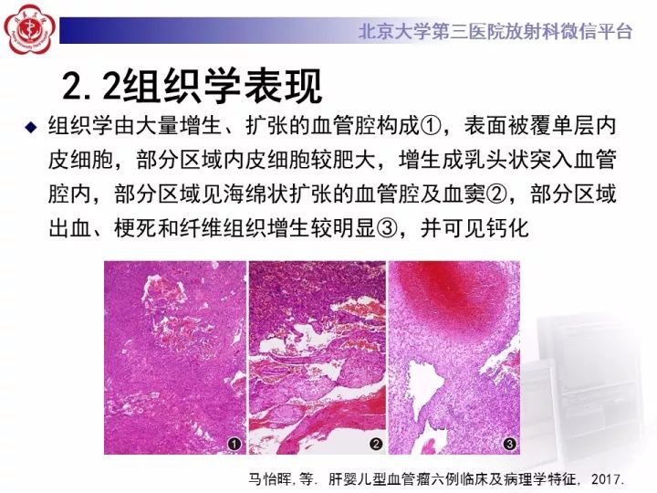 【PPT】肝脏血管源性肿瘤（一）