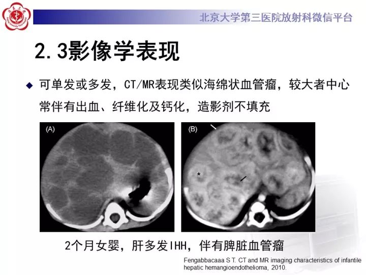 【PPT】肝脏血管源性肿瘤（一）