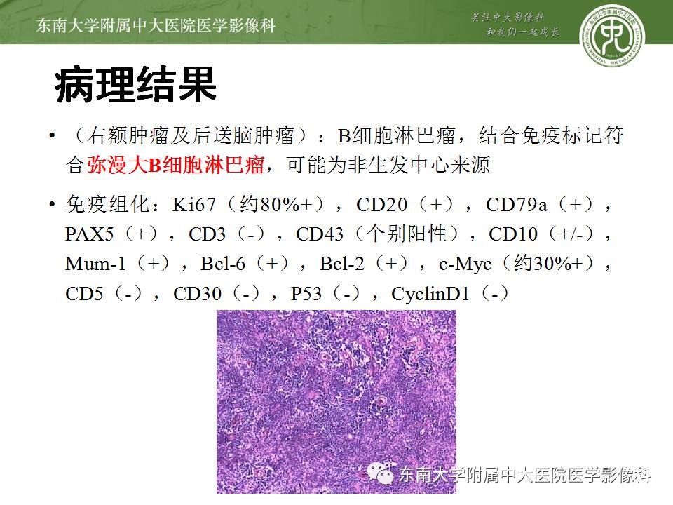 【病例】中枢神经系统淋巴瘤1例CT及MR影像诊断
