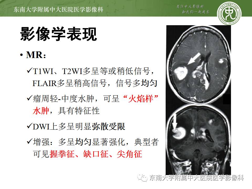 【病例】中枢神经系统淋巴瘤1例CT及MR影像诊断
