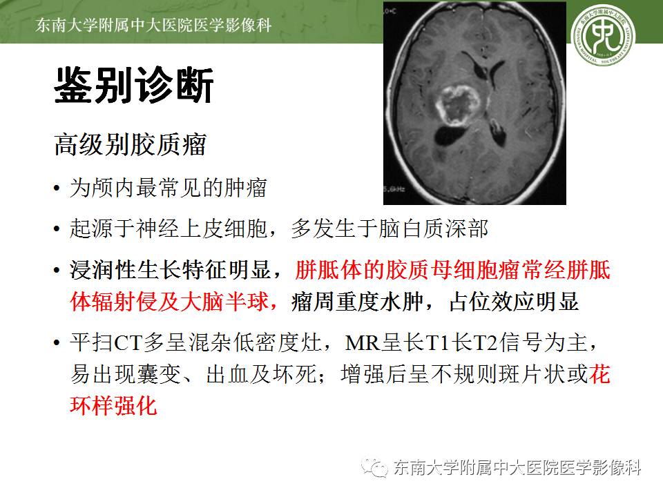 【病例】中枢神经系统淋巴瘤1例CT及MR影像诊断