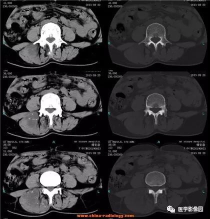 【病例】骶骨软骨肉瘤1例CT影像表现