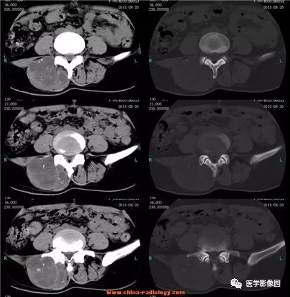 【病例】骶骨软骨肉瘤1例CT影像表现 【病例】骶骨软骨肉瘤1例CT影像表现