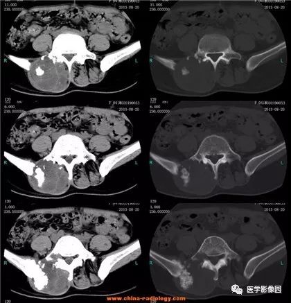【病例】骶骨软骨肉瘤1例CT影像表现 【病例】骶骨软骨肉瘤1例CT影像表现