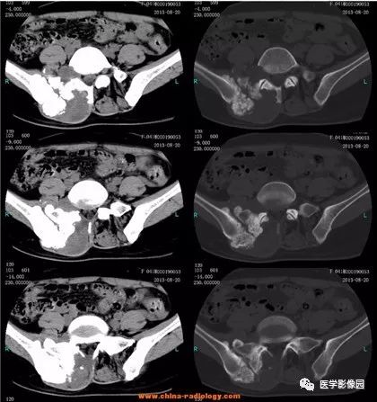 【病例】骶骨软骨肉瘤1例CT影像表现 【病例】骶骨软骨肉瘤1例CT影像表现
