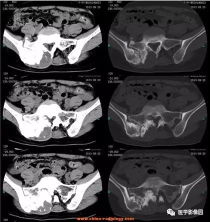 【病例】骶骨软骨肉瘤1例CT影像表现 【病例】骶骨软骨肉瘤1例CT影像表现