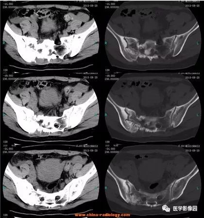 【病例】骶骨软骨肉瘤1例CT影像表现 【病例】骶骨软骨肉瘤1例CT影像表现