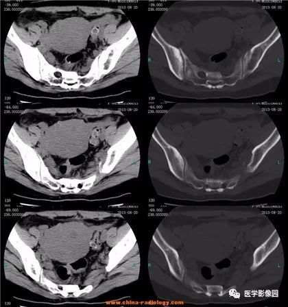 【病例】骶骨软骨肉瘤1例CT影像表现 【病例】骶骨软骨肉瘤1例CT影像表现