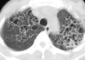 【病例】肺组织细胞增生症X一例CT
