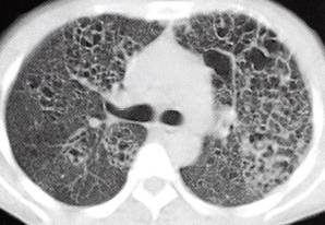 【病例】肺组织细胞增生症X一例CT 【病例】肺组织细胞增生症X一例CT