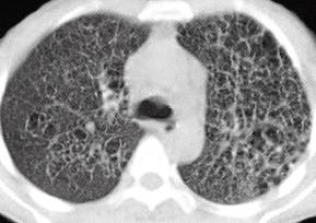 【病例】肺组织细胞增生症X一例CT 【病例】肺组织细胞增生症X一例CT