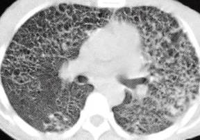 【病例】肺组织细胞增生症X一例CT 【病例】肺组织细胞增生症X一例CT