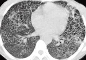 【病例】肺组织细胞增生症X一例CT 【病例】肺组织细胞增生症X一例CT