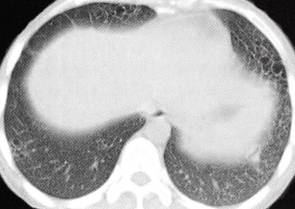 【病例】肺组织细胞增生症X一例CT 【病例】肺组织细胞增生症X一例CT