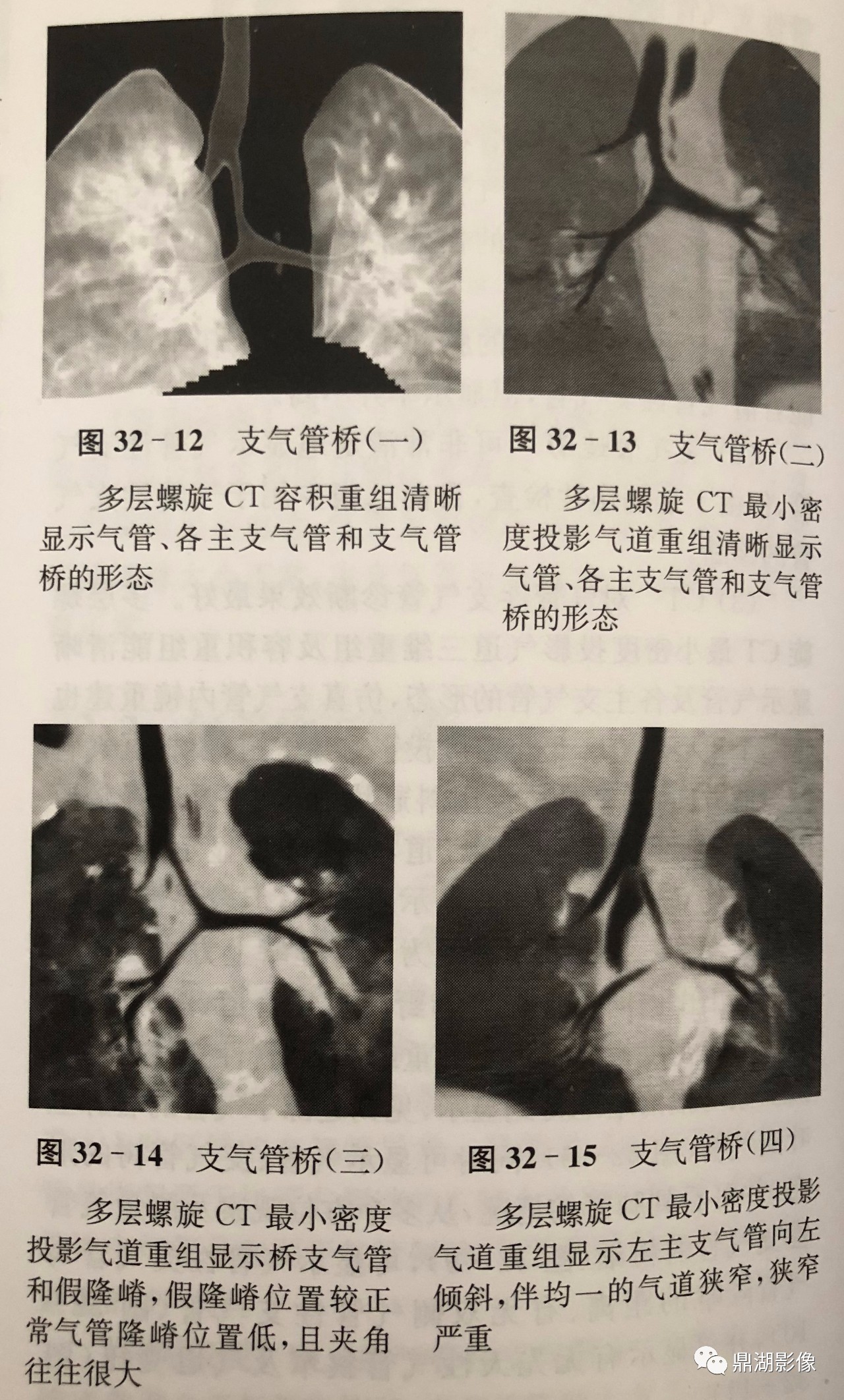 详细综述:支气管桥 详细综述:支气管桥