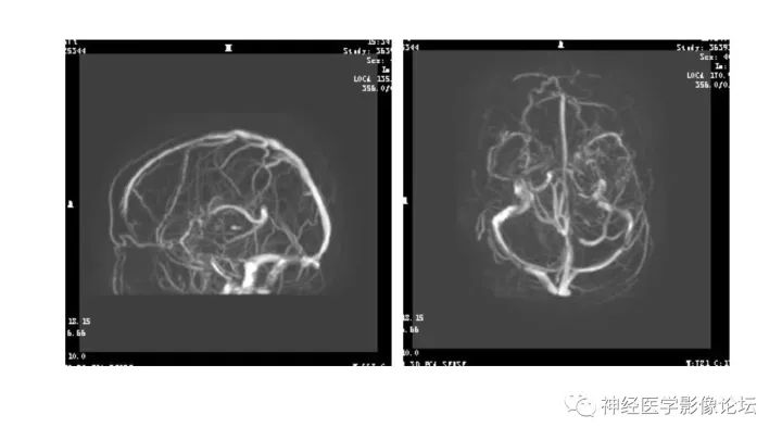 【病例】脑实质间变性室管膜瘤1例MR