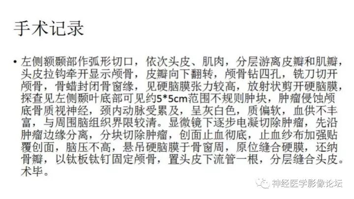 【病例】脑实质间变性室管膜瘤1例MR