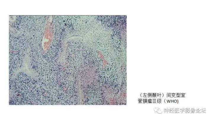 【病例】脑实质间变性室管膜瘤1例MR