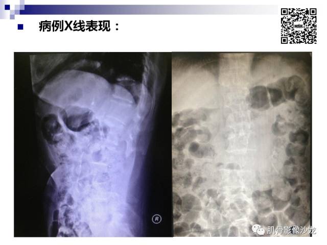 【病例】骨淋巴瘤5例影像讨论 【病例】骨淋巴瘤5例影像讨论