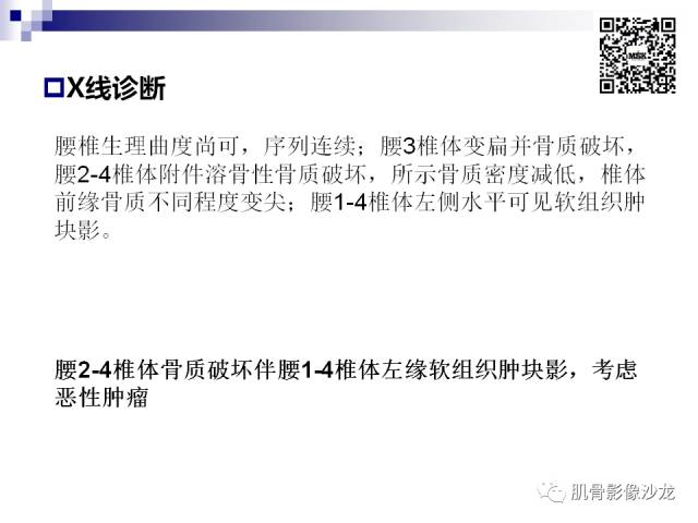 【病例】骨淋巴瘤5例影像讨论 【病例】骨淋巴瘤5例影像讨论