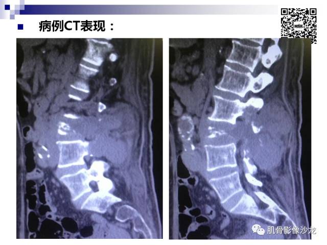 【病例】骨淋巴瘤5例影像讨论 【病例】骨淋巴瘤5例影像讨论