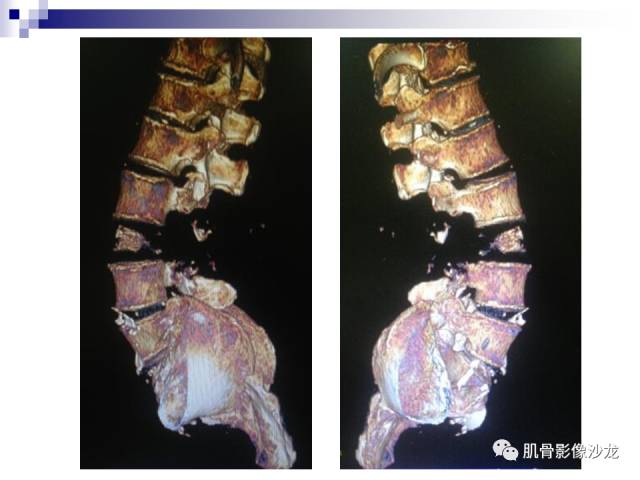 【病例】骨淋巴瘤5例影像讨论 【病例】骨淋巴瘤5例影像讨论
