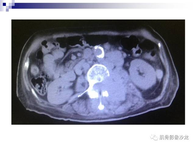 【病例】骨淋巴瘤5例影像讨论 【病例】骨淋巴瘤5例影像讨论