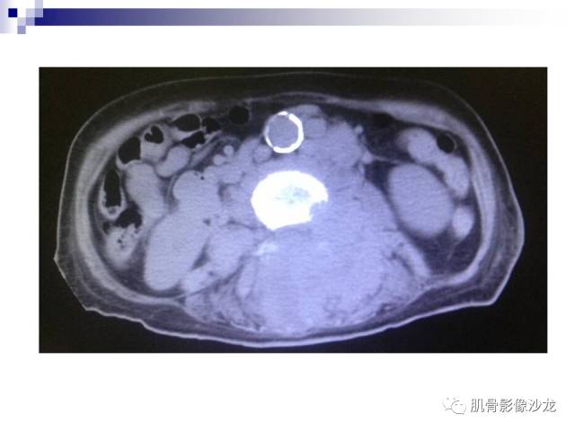 【病例】骨淋巴瘤5例影像讨论 【病例】骨淋巴瘤5例影像讨论