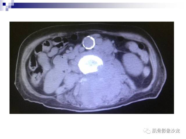 【病例】骨淋巴瘤5例影像讨论 【病例】骨淋巴瘤5例影像讨论