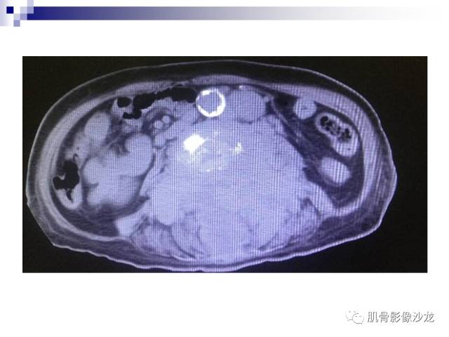 【病例】骨淋巴瘤5例影像讨论