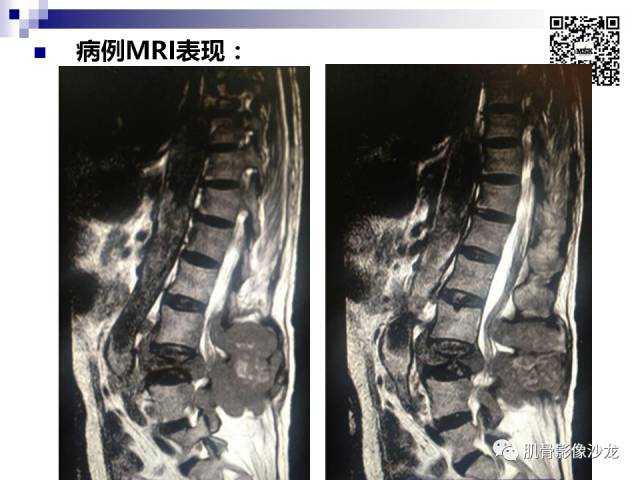 【病例】骨淋巴瘤5例影像讨论 【病例】骨淋巴瘤5例影像讨论