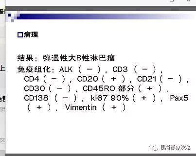 【病例】骨淋巴瘤5例影像讨论 【病例】骨淋巴瘤5例影像讨论