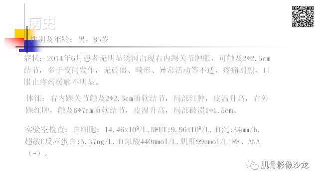 【病例】骨淋巴瘤5例影像讨论 【病例】骨淋巴瘤5例影像讨论