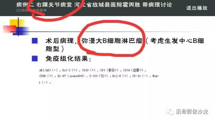 【病例】骨淋巴瘤5例影像讨论 【病例】骨淋巴瘤5例影像讨论