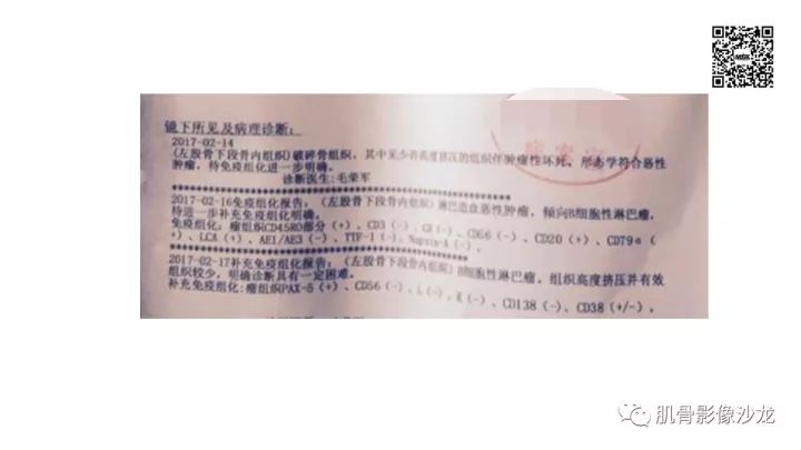 【病例】骨淋巴瘤5例影像讨论 【病例】骨淋巴瘤5例影像讨论