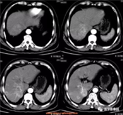 【病例】肝内胆管细胞癌1例CT影像表现 【病例】肝内胆管细胞癌1例CT影像表现