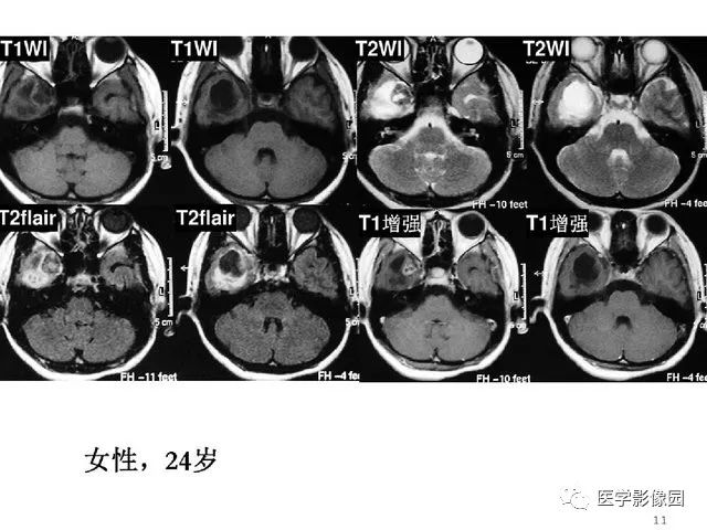 【PPT】颅内少见囊性肿瘤性病变影像诊断