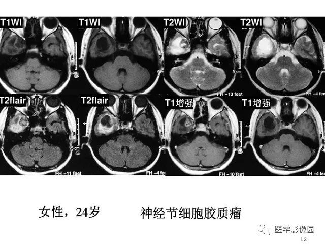 【PPT】颅内少见囊性肿瘤性病变影像诊断