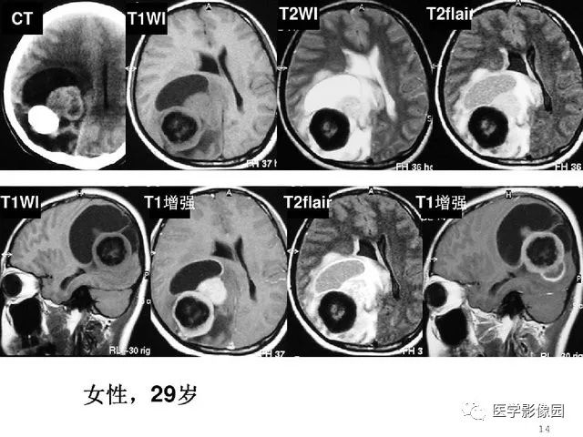 【PPT】颅内少见囊性肿瘤性病变影像诊断