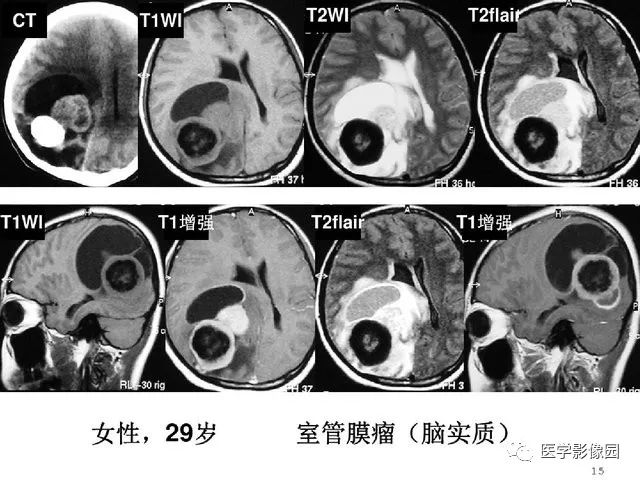 【PPT】颅内少见囊性肿瘤性病变影像诊断